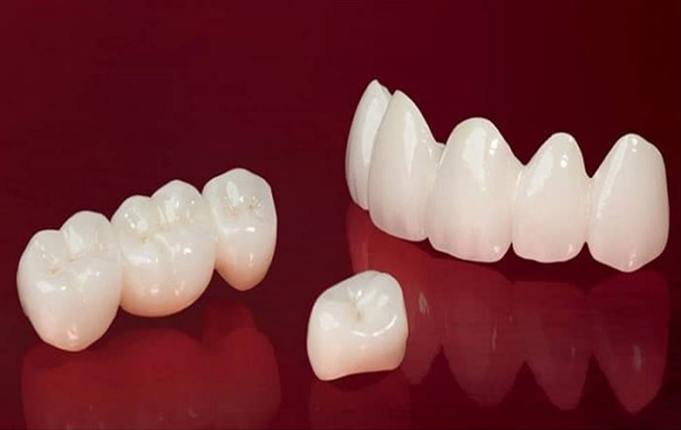 ایا کامپوزیت دندان باعث پ.سیدگی دندانها میشود؟
