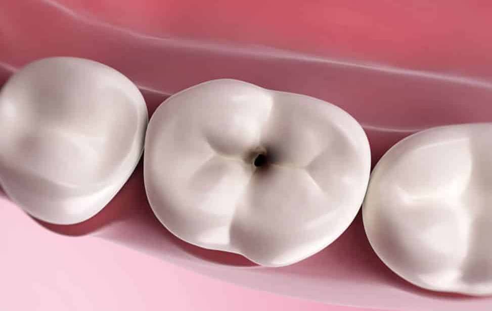 مراحل درمان پوسیدگی دندان